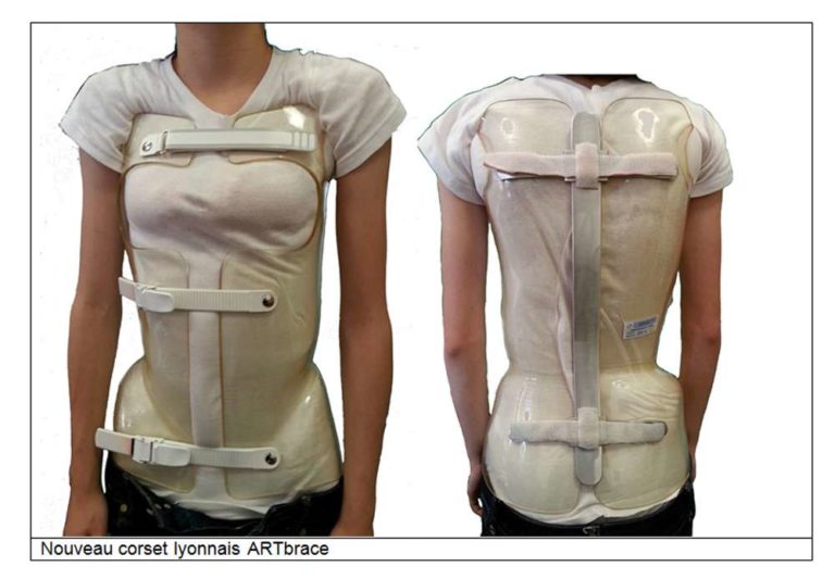 Astuces Comment dormir avec un corset pour scoliose
