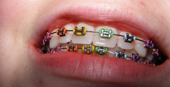 Comment choisir la couleur de son appareil dentaire ?