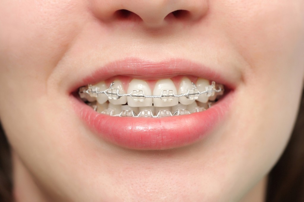 Est-ce que les dents en céramique jaunissent ?