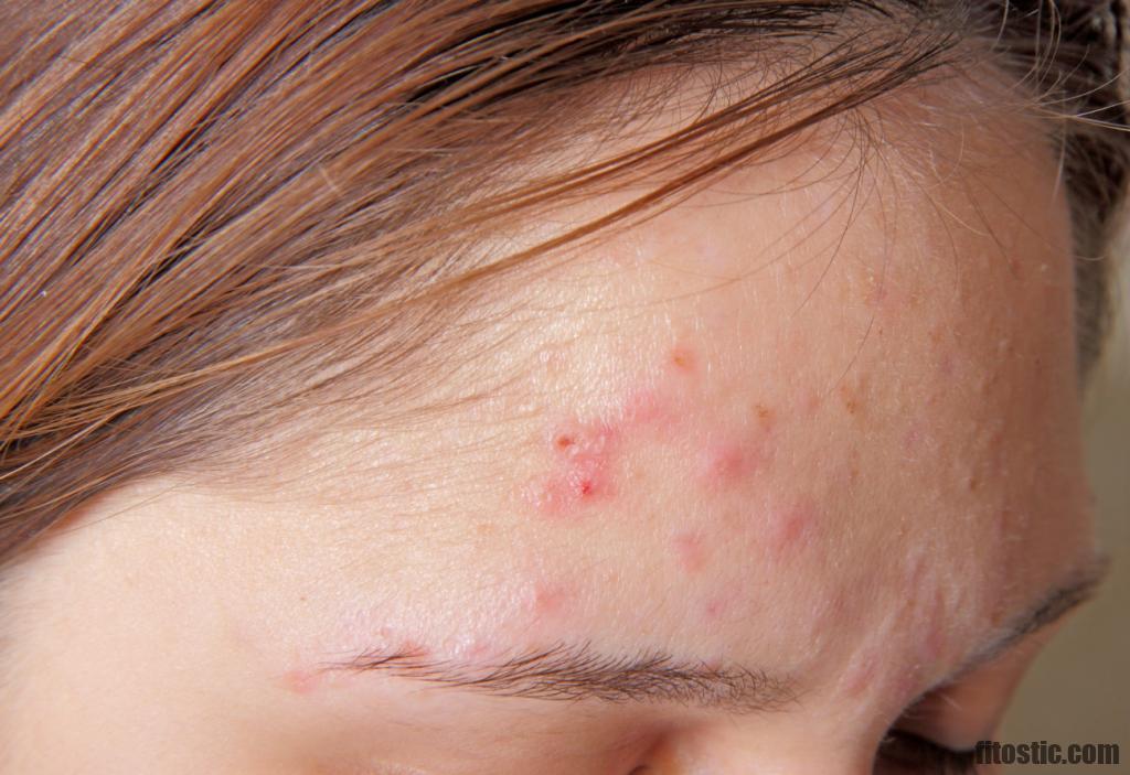 Pourquoi Des Boutons Sur Les Joues