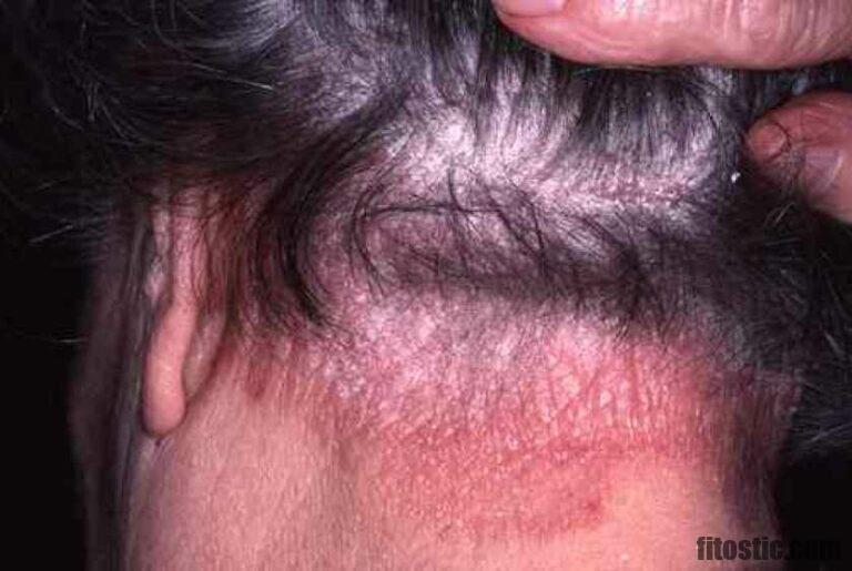 Comment Soigner Une Dermatite Du Cuir Chevelu