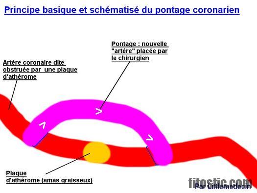 C'est quoi une décompensation cardiaque ?