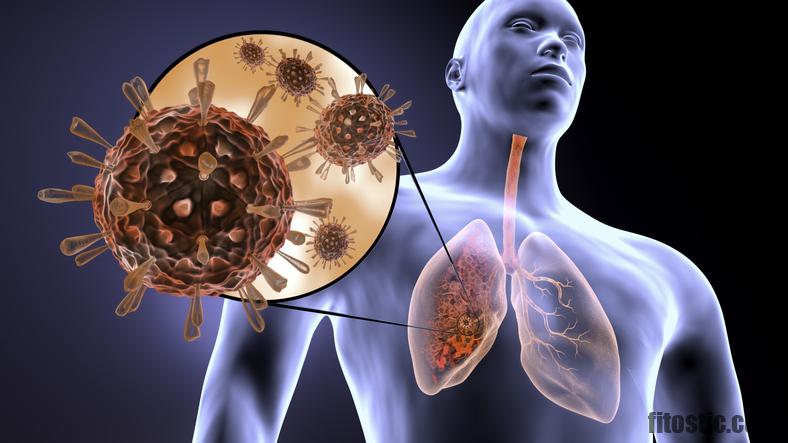 Comment Soigne-t-on une infection pulmonaire ?