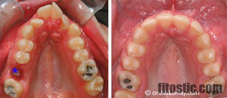 Comment accelerer la cicatrisation après extraction dentaire ?