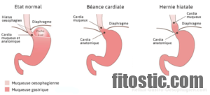 Comment apprendre à vivre avec une hernie hiatale ?