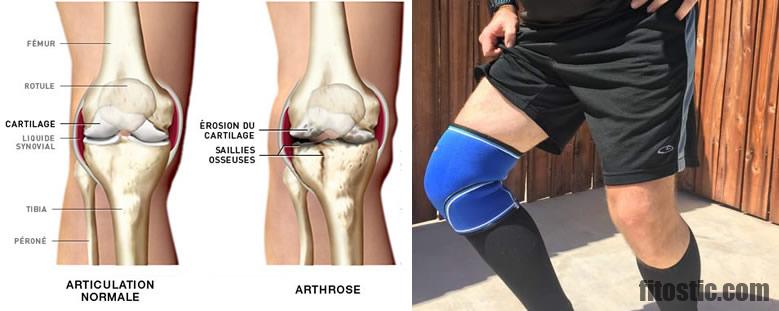 Comment arrêter la progression de l'arthrose ?