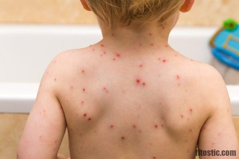 Comment calmer les démangeaisons de la varicelle ?