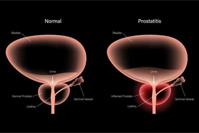 Comment detecter une prostatite chronique ?