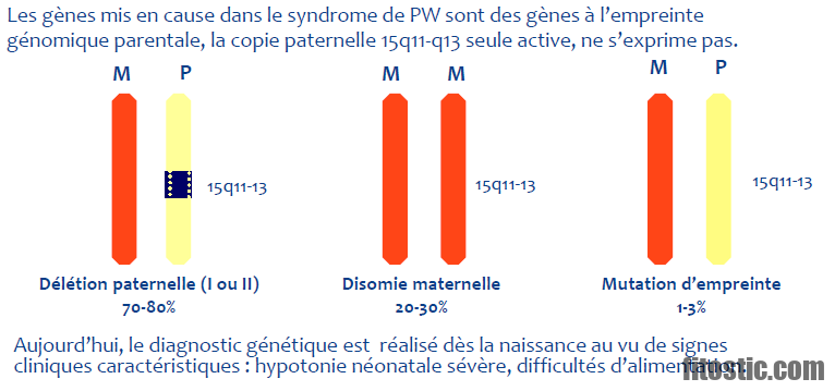 Comment diagnostiquer le syndrome de Prader-willi ?