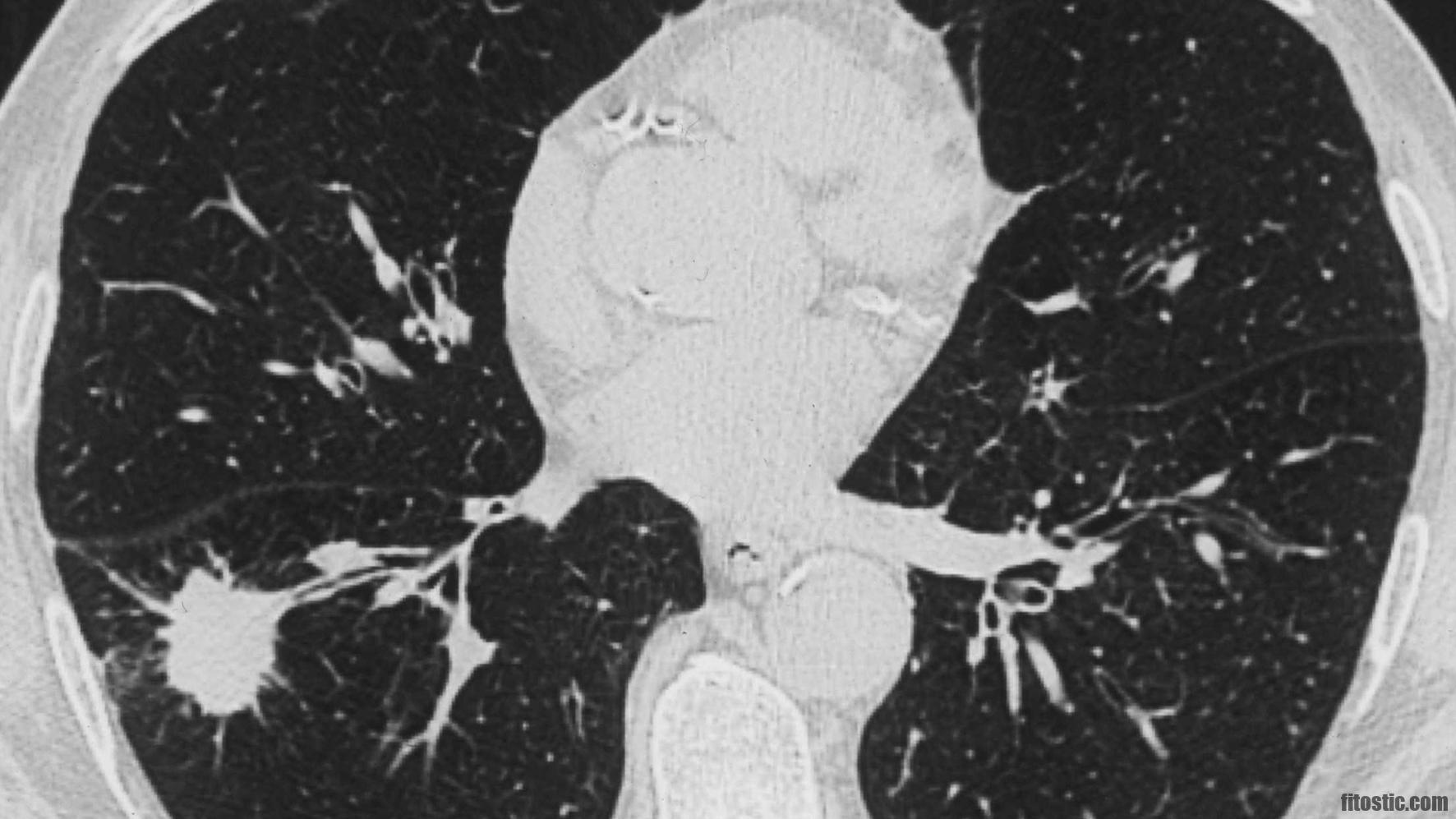 Comment diagnostiquer un pneumothorax ?