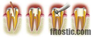 Comment endormir le nerf d'une dent ?