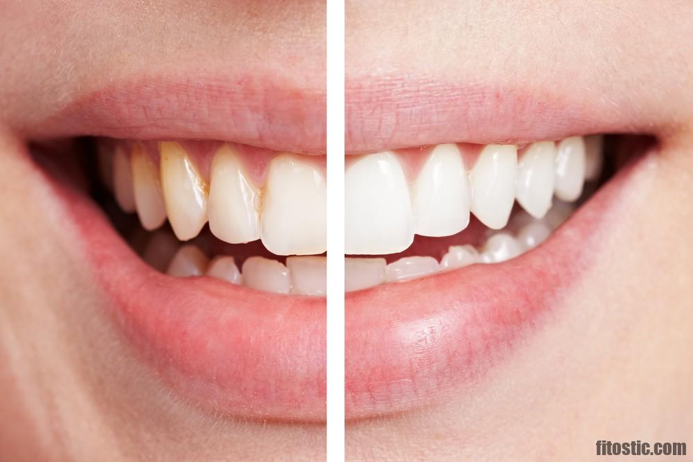 Comment enlever le plombage des dents ?