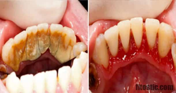 Comment enlever le tartre des dents remède de Grand-mère ?