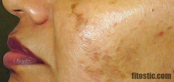 Comment Enlever Les Taches Du Visage Rapidement Fitostic Com Sport Mode Beaute Lifestyle Magazine Comment Enlever Les Taches Du Visage Rapidement Fitostic Com Sport Mode Beaute Lifestyle Magazine