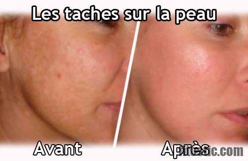 Comment enlever les taches sur le visage recette maison ?