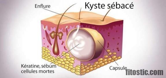 Comment enlever un kyste dentaire naturellement ?