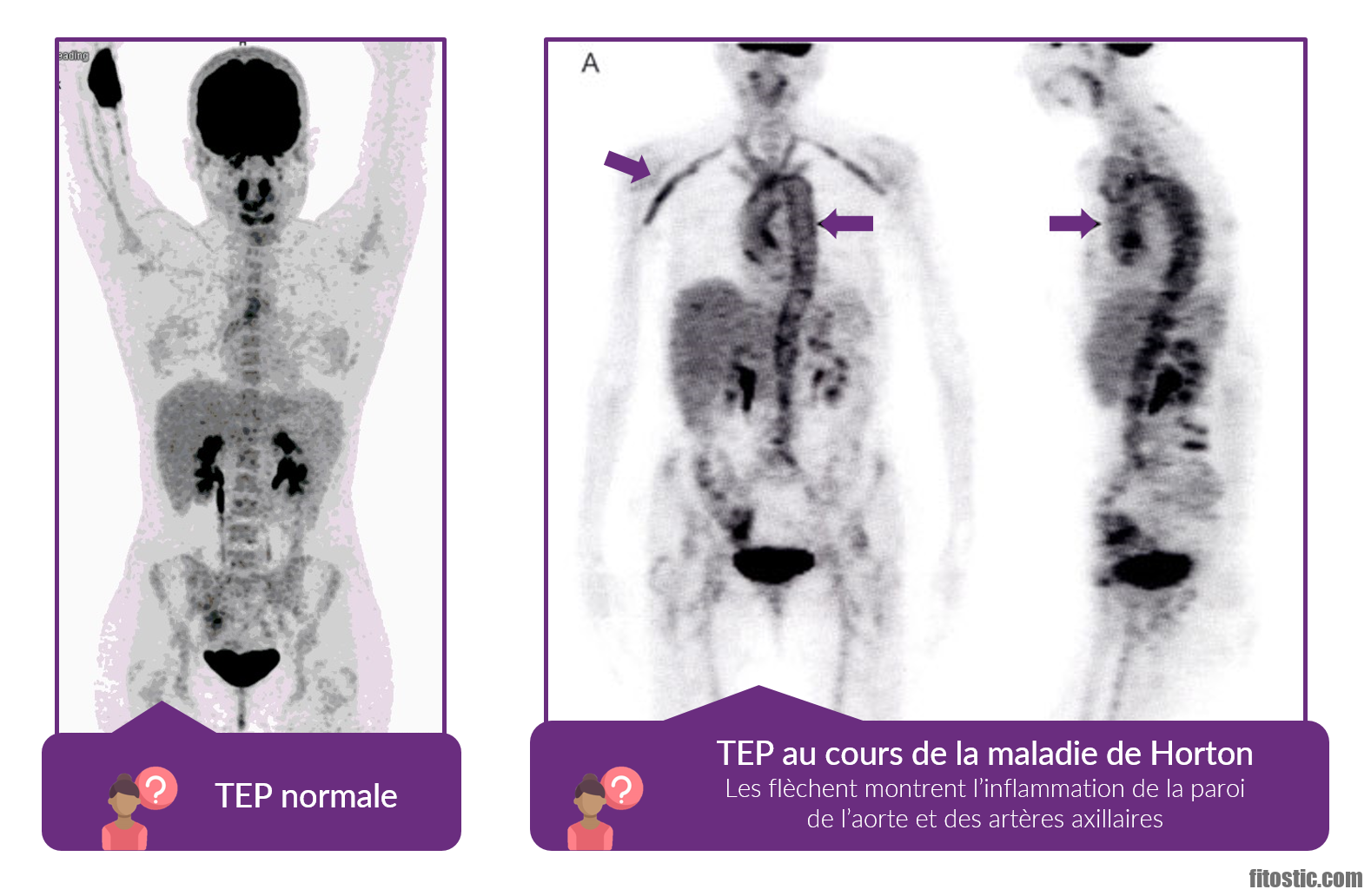 Comment évolue la maladie de Waldenstrom ?