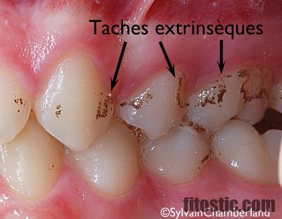 Comment faire disparaître les taches noires sur les dents ?