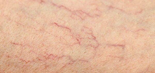 Comment faire disparaître les vaisseaux sur les jambes ? - Fitostic.com ...
