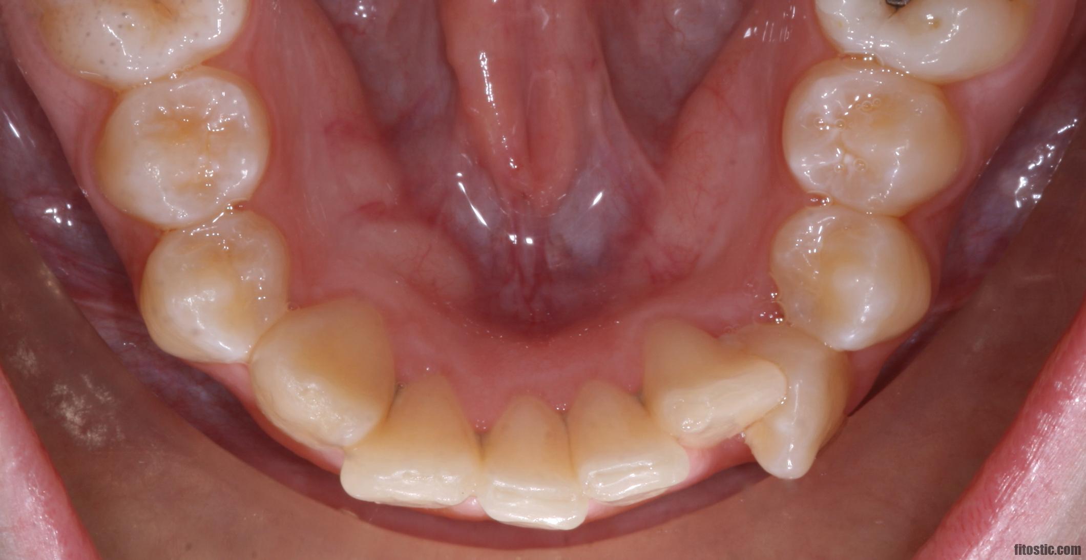 Comment faire si on a des dents pourries ?