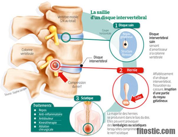 Comment guérir d'une glossite ?