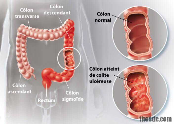 Comment guérir d'une rectocolite hémorragique ?