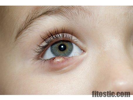 Comment péter un chalazion ?