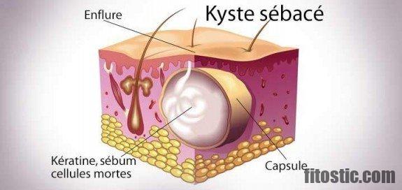 Comment reconnaître un kyste au toucher ?