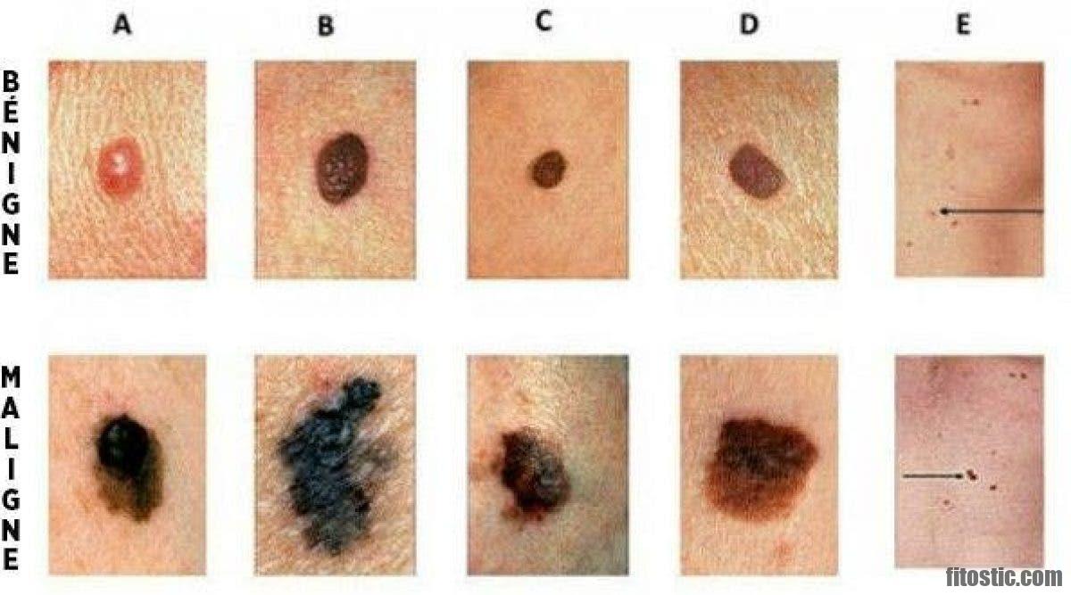 Comment reconnaître une Fasciculation ?