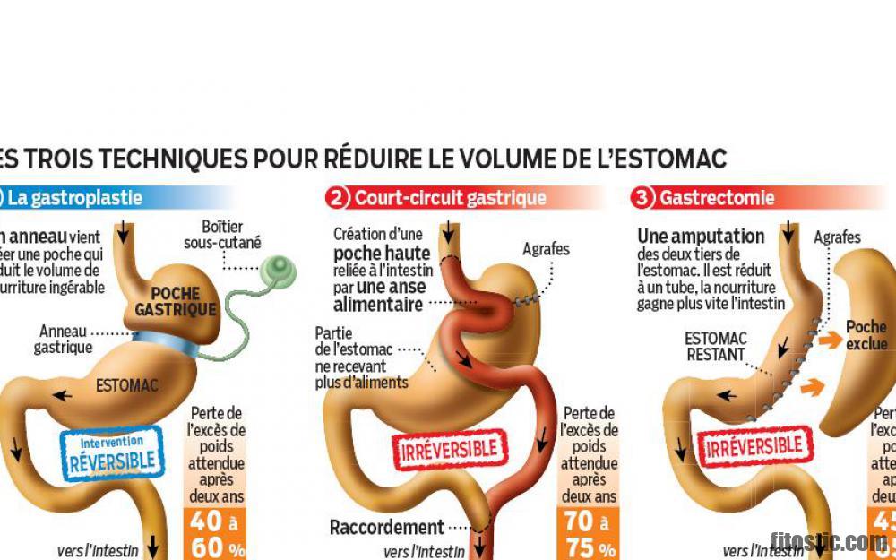 Comment réduire son estomac sans opération ?