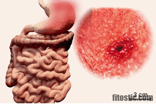 Comment régénérer la muqueuse de l'estomac ?