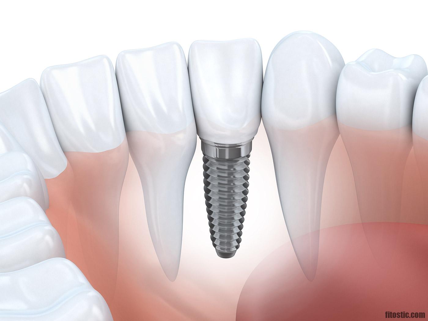 Comment remplacer une molaire sans implant ?