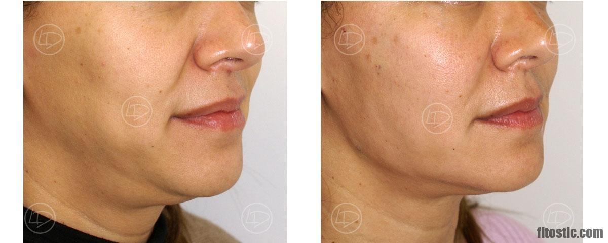 Comment retendre la peau du visage sans chirurgie ?