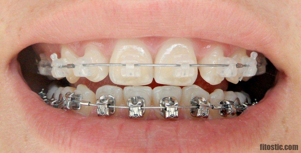 Comment s'appellent les deux dents de devant ?