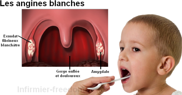 Angine Gorge Patch's Rouges Comment s'attrape une angine herpétique ? - Fitostic.com - Sport, Mode ...