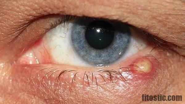 Comment savoir si j'ai un orgelet ou un chalazion ?