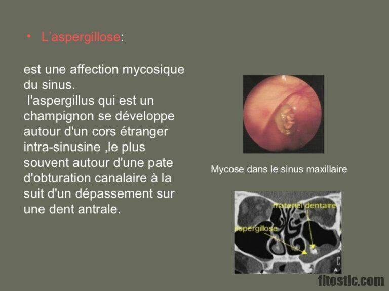 Comment savoir si la sinusite est d