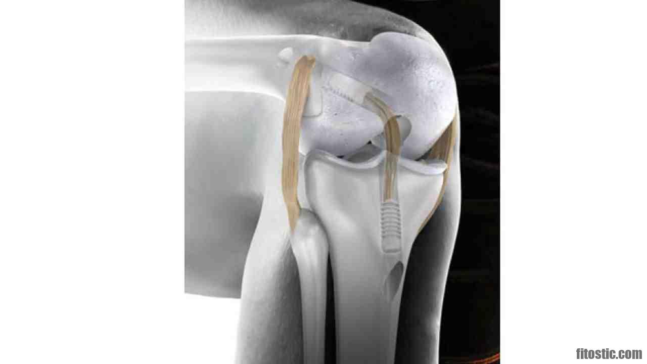 Comment savoir si le ligament de la cheville est rompu ?