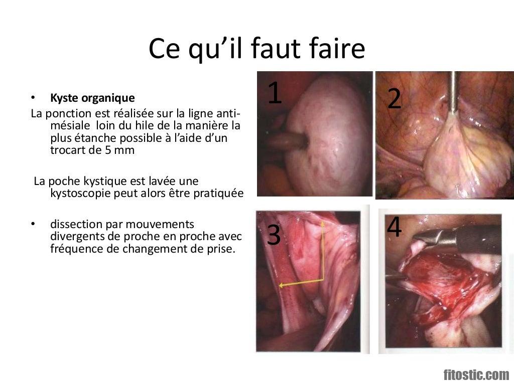 Comment savoir si on a des ovaire polykystique ?