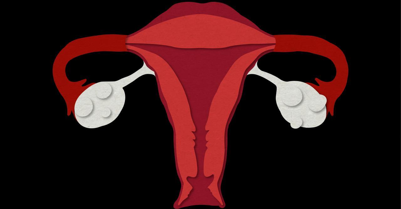Comment savoir si on a le syndrome des ovaires polykystiques ?