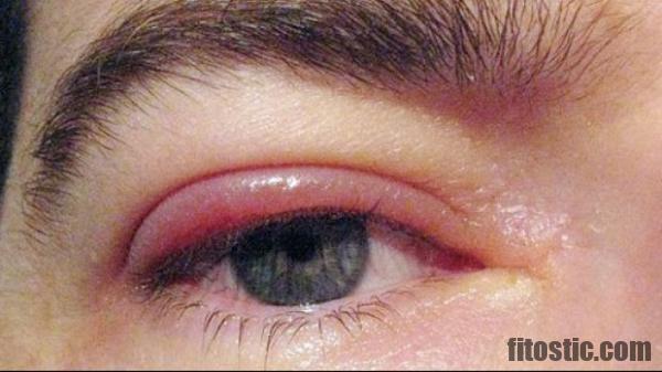 Comment savoir si on a un chalazion ou un orgelet ?