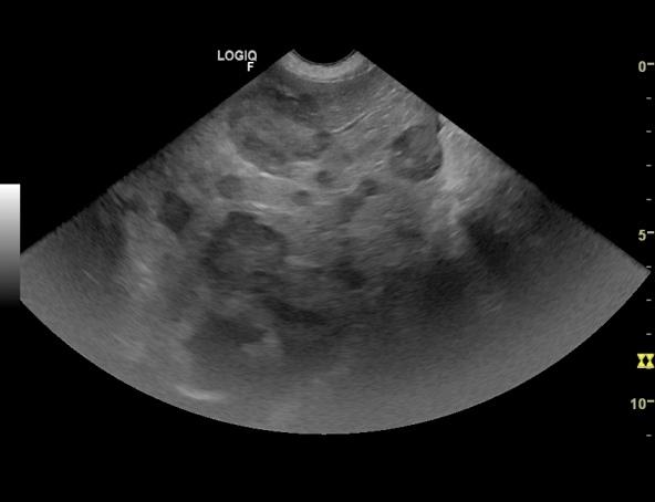 Comment savoir si on a une tumeur au thorax ?