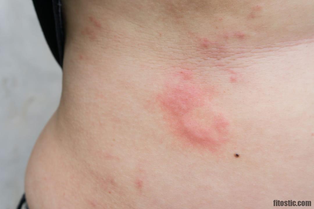 Comment savoir si on est allergique à l'histamine ?