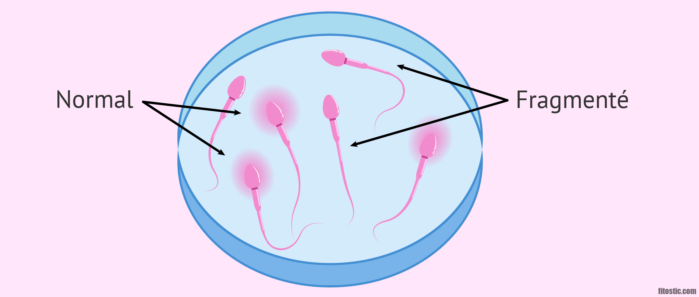 Comment savoir si on est stérile à cause d'une chlamydia ?