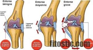 Comment savoir si une entorse du genou est grave ?