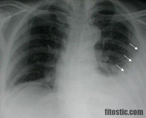 Comment se Resorbe un épanchement pleural ?