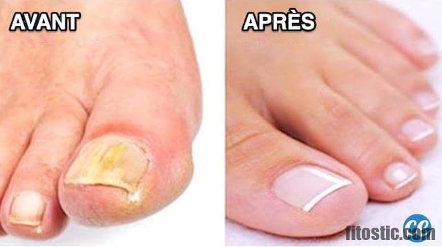 Comment se débarrasser de la mycose des ongles de pieds ?