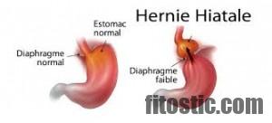 Comment se débarrasser d'une hernie hiatale ?