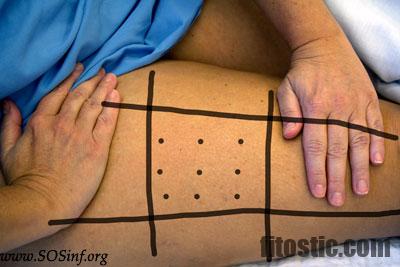 Puregon Injection Position Comment se faire une injection de Puregon ? - Fitostic.com - Sport ...