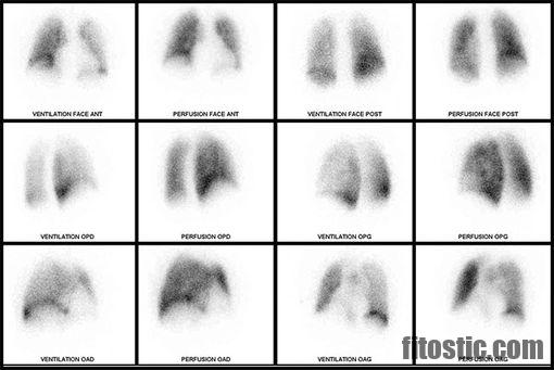Comment se passe l'examen d'une scintigraphie ?